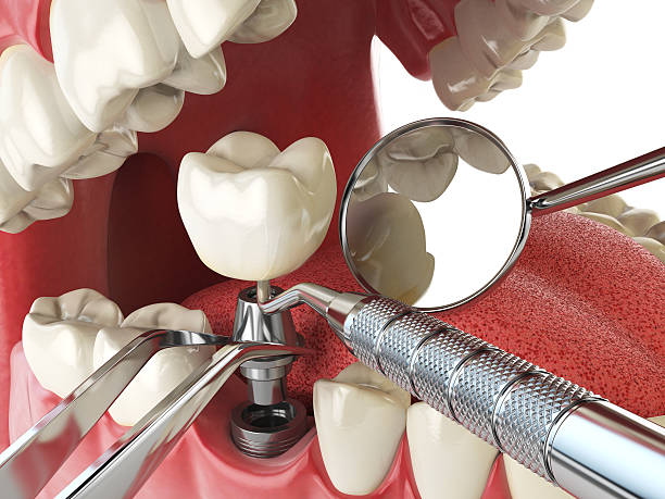 Best Root Canal Emergency Dentist  in Rouse, CA